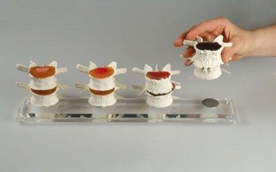 Actual product image Erler Zimmer Anatomical model Stages of intervertebral disc damage