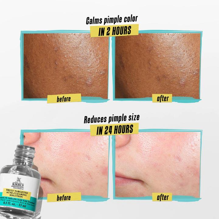 Actual product image Kiehl's Acne Clearing Solution 15 ml (Facial cleansing wipes, 65 g)