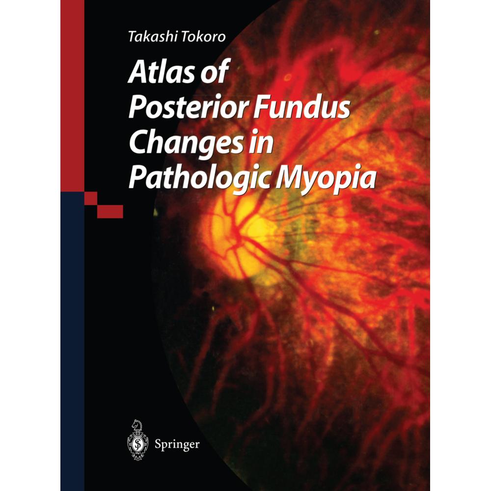 Atlas of Posterior Fundus Changes in Pathologic Myopia, Fachbücher von Takashi Tokoro