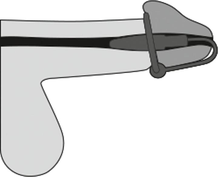 Produktbild You2Toys Eichelring Dilator