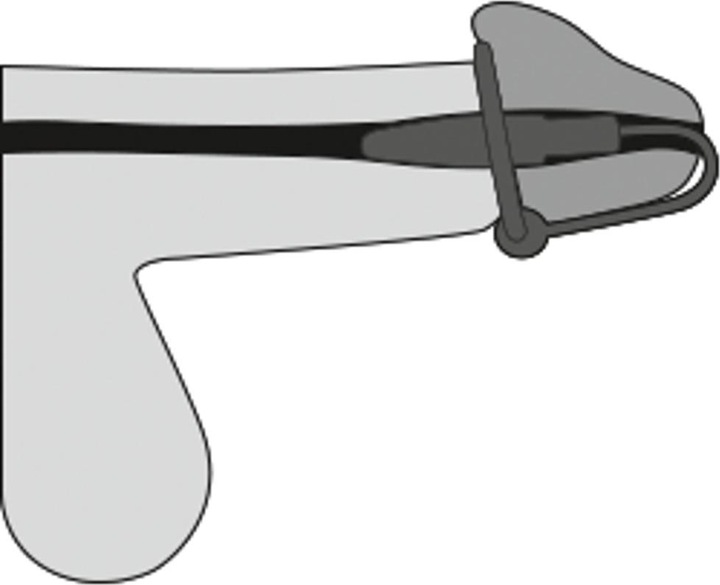 Produktbild You2Toys Eichelring Dilator