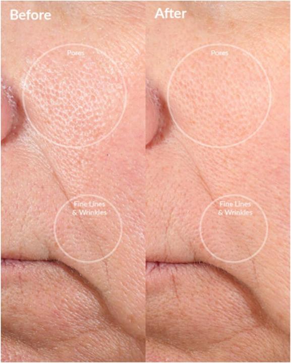 Actual product image PMD Personal Microderm Pro Berry