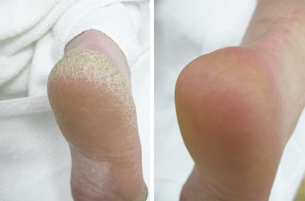Produktbild Footlogix Callus Softener 18 inkl. GRATIS Footfile (200 ml)