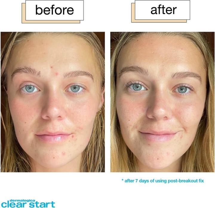 Produktbild Dermalogica Clear Start - Post-Breakout Fix (Körpercreme)