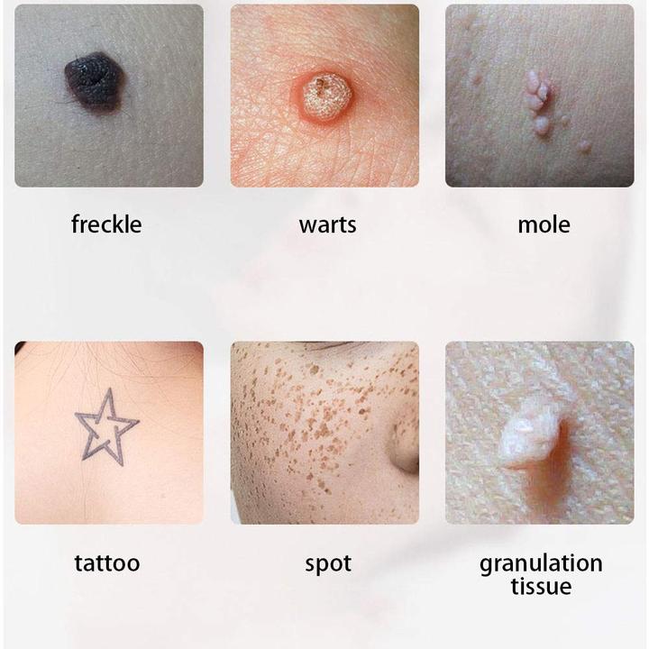 Produktbild Filfeel Skin Tags Remover Pen