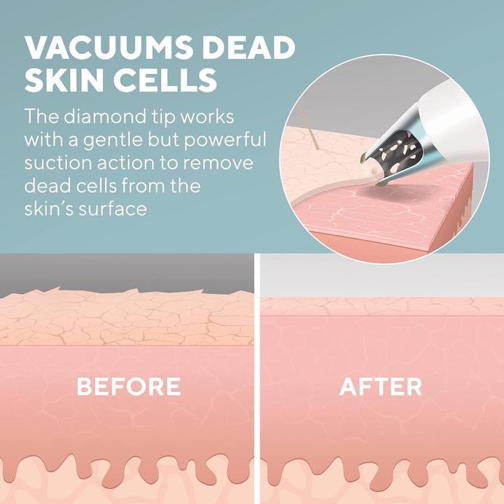 Image du produit Homedics MD-1000 Remove