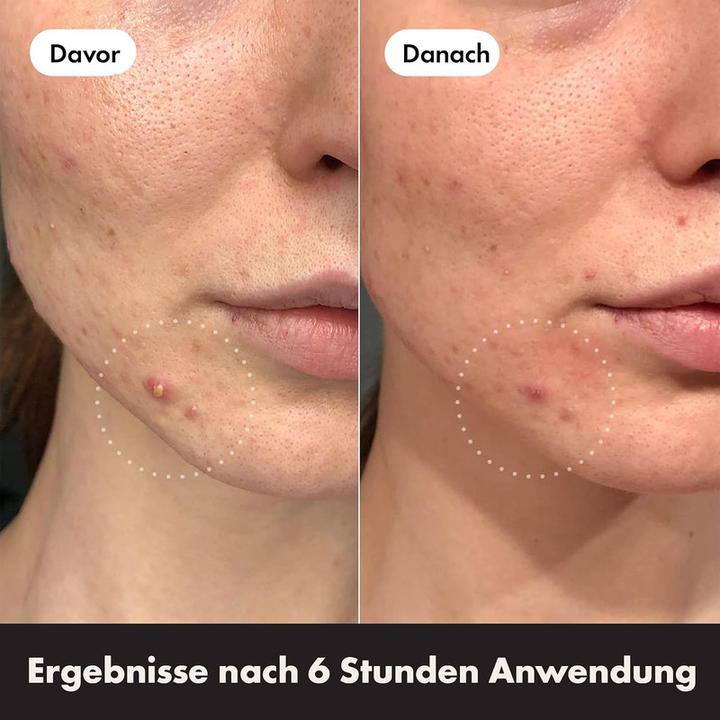 Produktbild Hero.Mighty Patch Duo (11 g)