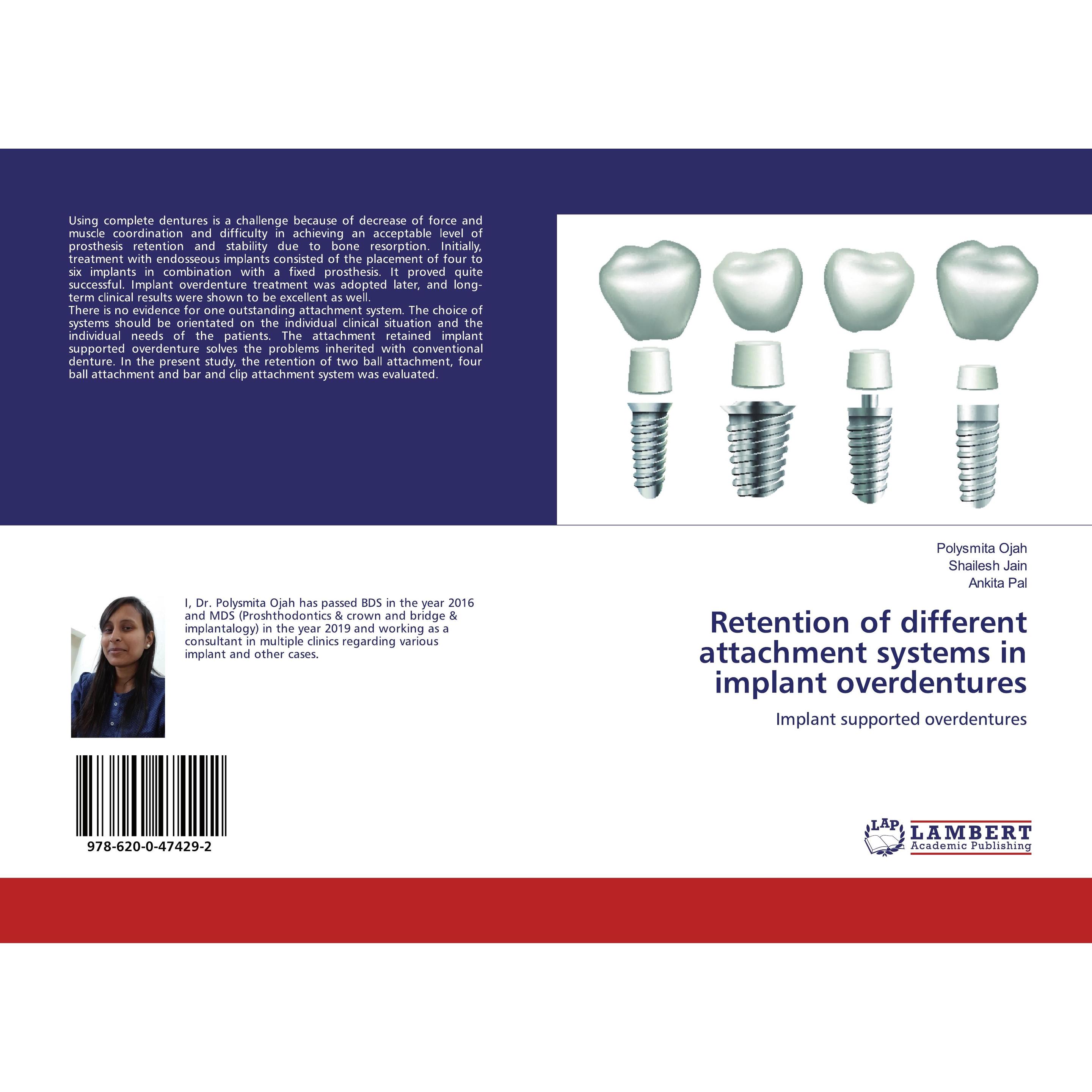 Thumbnail - Retention of different attachment systems in implant overdentures, Fachbücher von Polysmita Ojah Shailesh Jain Ankita Pa...
