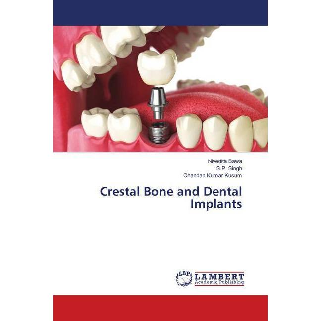 Crestal Bone and Dental Implants, Fachbücher von S. P. Singh, Nivedita Bawa, Chandan Kumar Kusum
