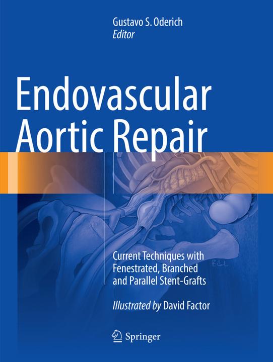 Actual product image Endovascular Aortic Repair (English, 2018)
