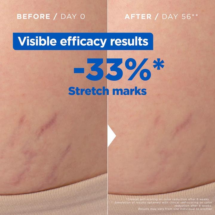 Produktbild Mixa Stretch Mark Oil (Körperöl, 100 ml)