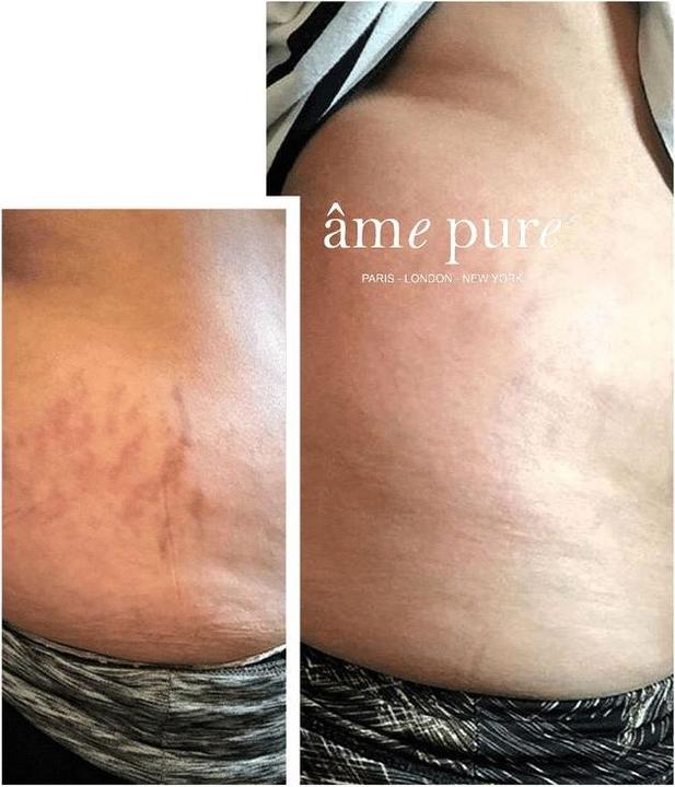 Actual product image Âme pure Basic Stretch Mark Eraser Set