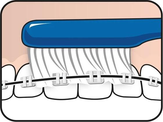 Image du produit TePe Brossette orthodontique Implant (Moyen, 1x)