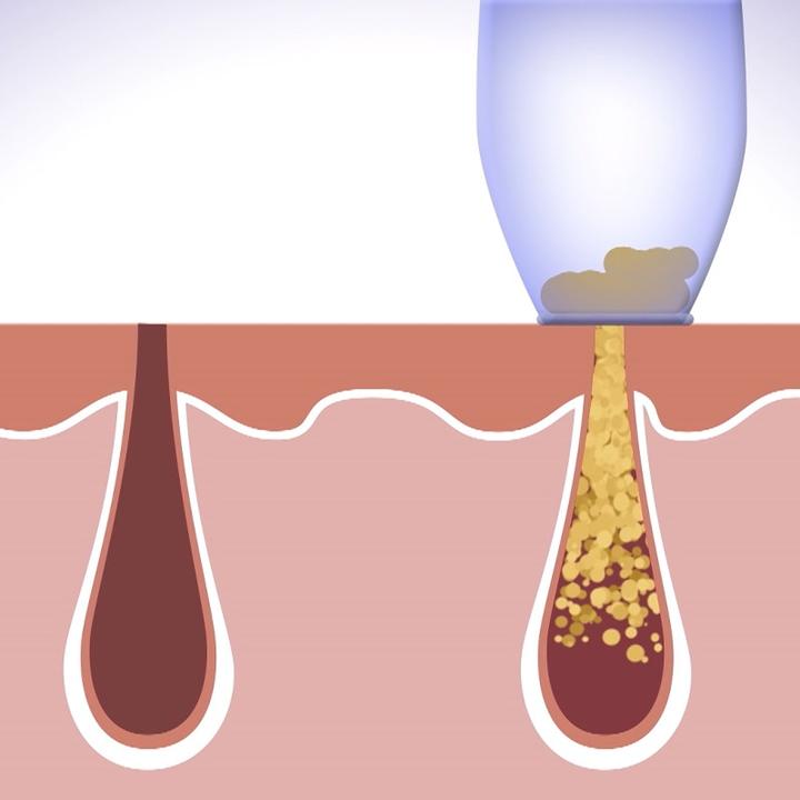 Actual product image MediaShop Derma Suction