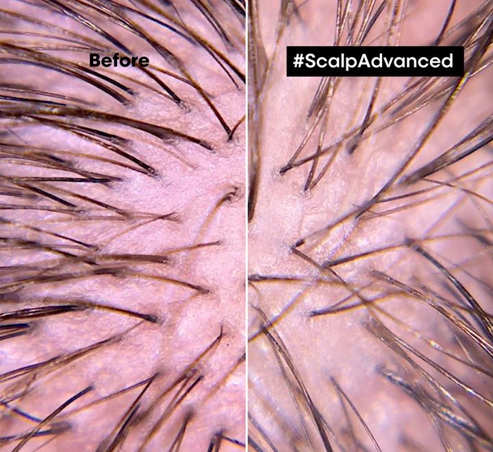 Produktbild L'Oréal Professionnel Scalp Advanced (200 ml)
