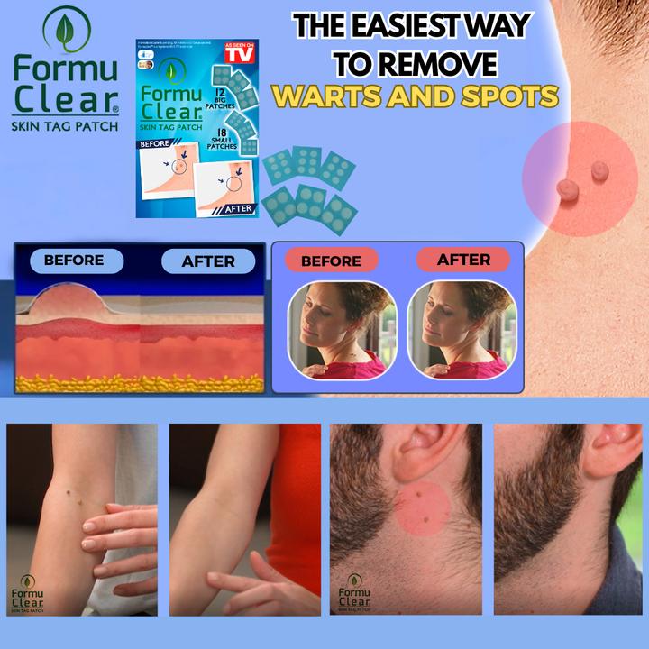 Produktbild Formu Clear Skin Tag Patch (Fusspflaster)