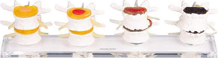 Actual product image Erler Zimmer Anatomical model Stages of intervertebral disc damage
