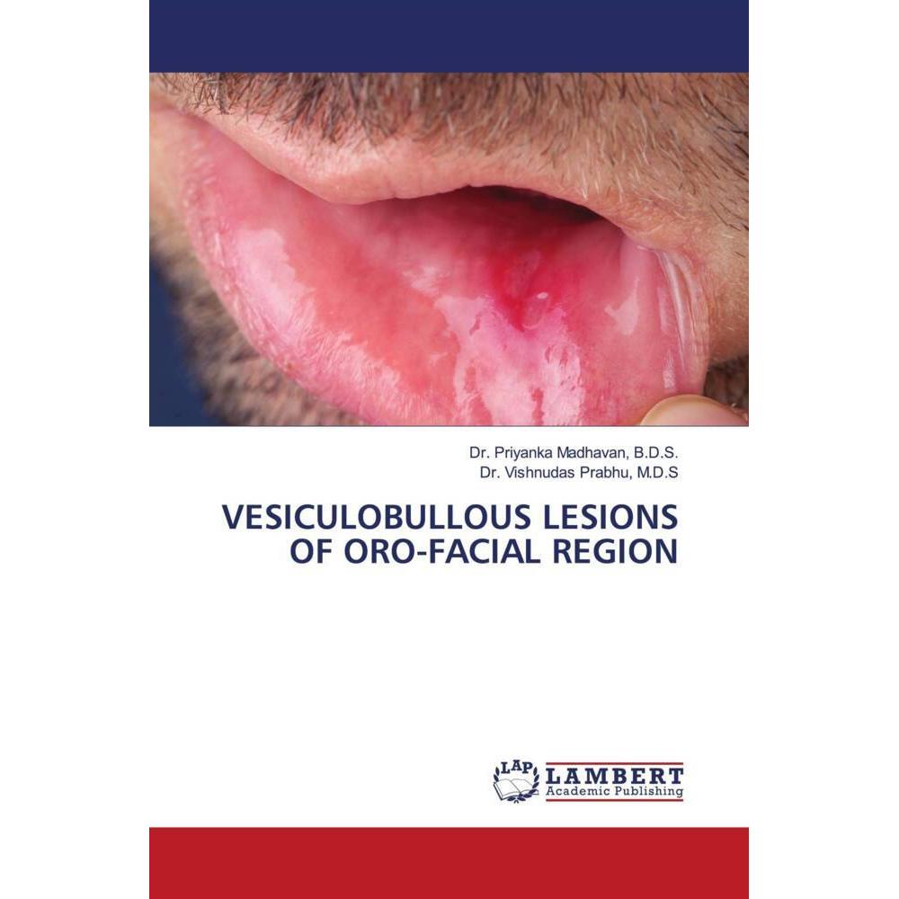Vesiculobullous Lesions Of Oro-Facial Region, Fachbücher von Dr. Priyanka Madhavan, Dr. Vishnudas Prabhu, M.D.S, B.D.S.
