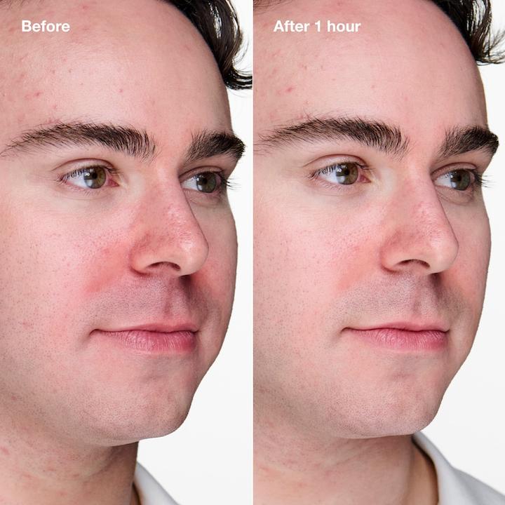 Image du produit Clinique Acne Solutions Clinical Advanced Clearing Gel​ (Gel nettoyant, 20 ml)