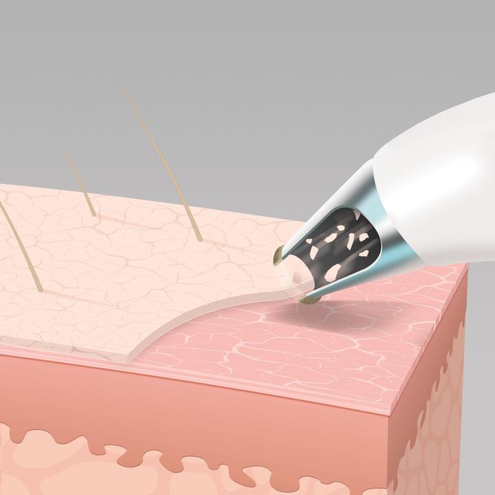 Image du produit Homedics MD-1000 Remove