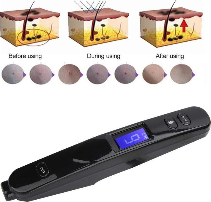 Produktbild Filfeel Skin Tags Remover Pen