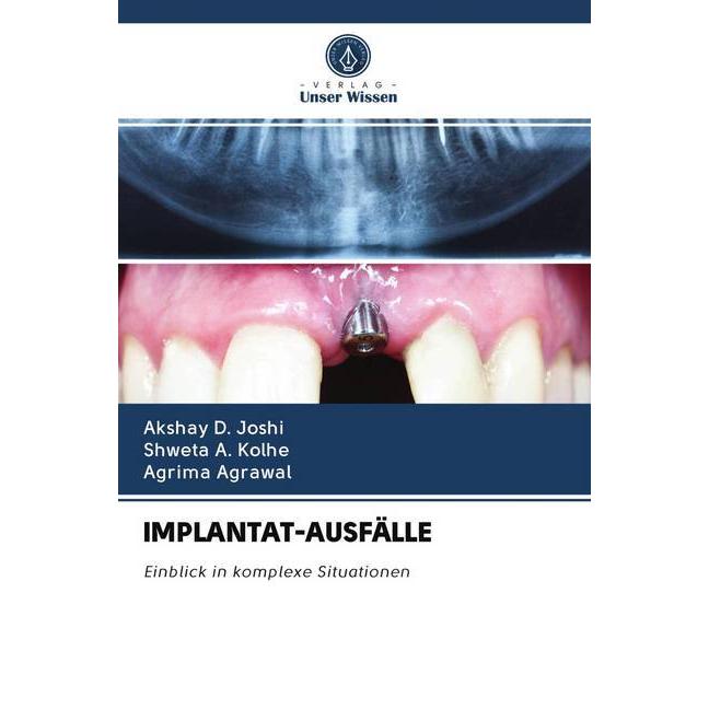 Implantat-Ausfälle, Fachbücher von Akshay D. Joshi, Shweta A. Kolhe, Agrima Agrawal