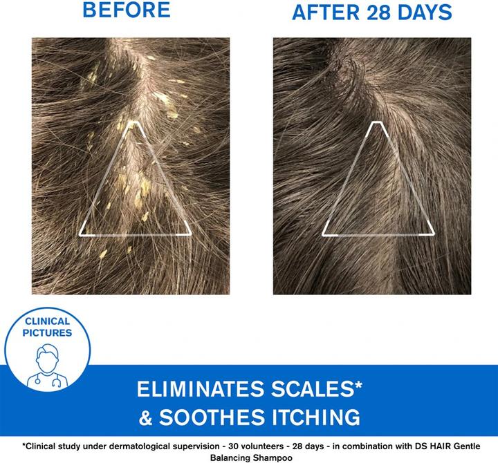 Productafbeelding Uriage DS Hair Kerato-verminderende shampoo (Vloeibare shampoo, 150 ml)