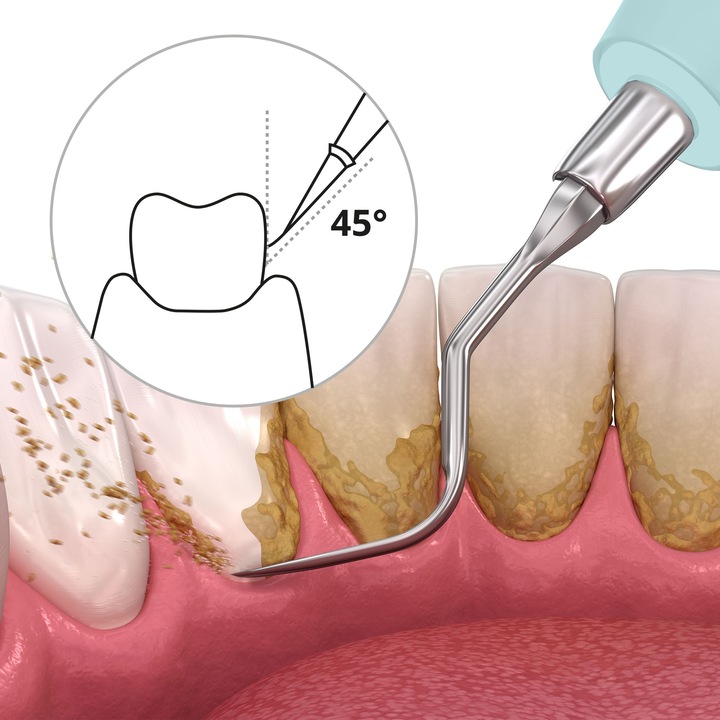 Actual product image Ailoria Deplaqued (Sonic tooth cleaner)