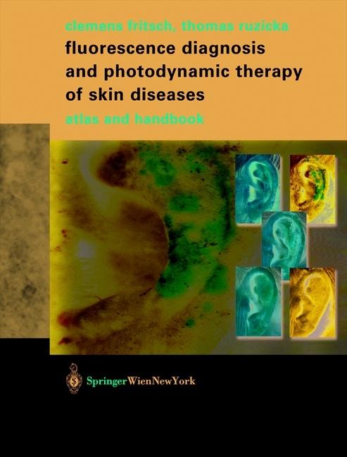 Produktbild Fluorescence Diagnosis and Photodynamic Therapy of Skin Diseases (Englisch, Clemens Fritsch, Thomas Ruzicka, 2013)