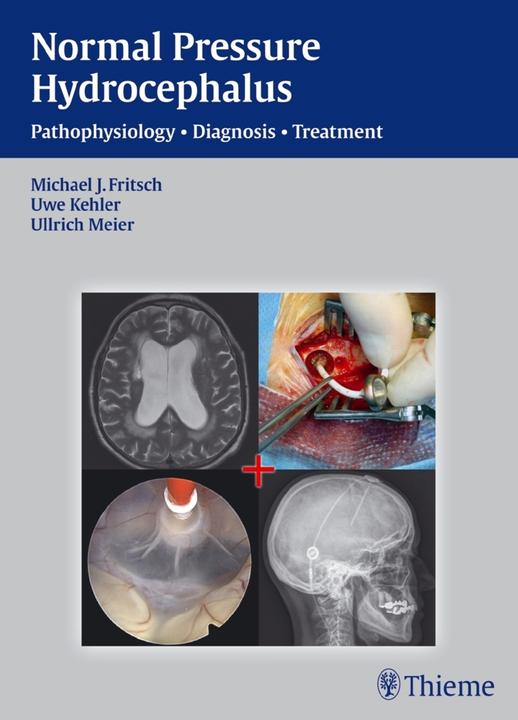 Produktbild NPH - Normal Pressure Hydrocephalus (Englisch, Michael J. Fritsch, Ullrich Meier, Uwe Kehler, 2014)