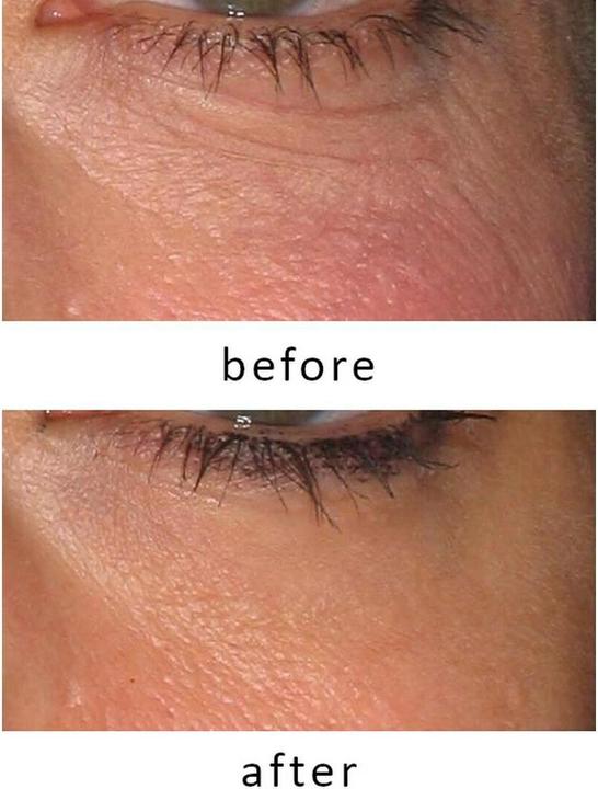 Productafbeelding Silk'n Revive