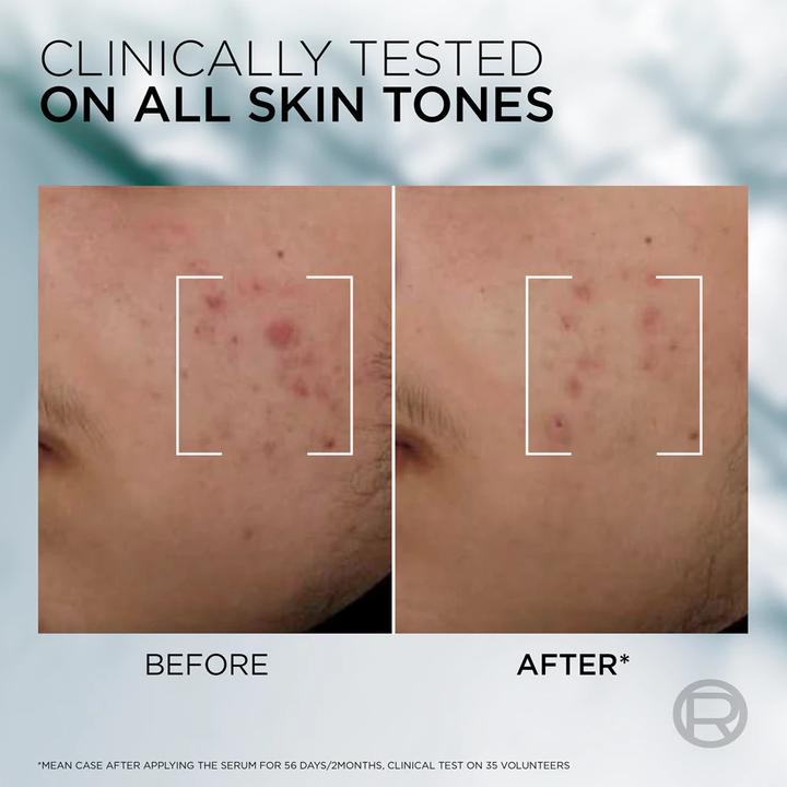 Actual product image L'Oréal Paris Men Expert Derma Control Anti-Blemish Serum (30 ml)