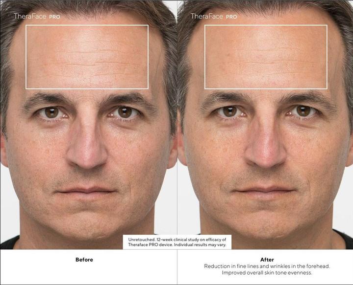 Produktbild Therabody TheraFace PRO, schwarz