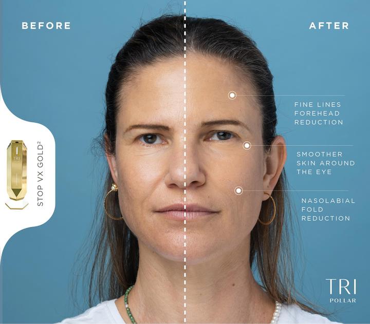 Image du produit TriPollar VX Gold2 soin ultime de la peau anti-âge RF-DMA