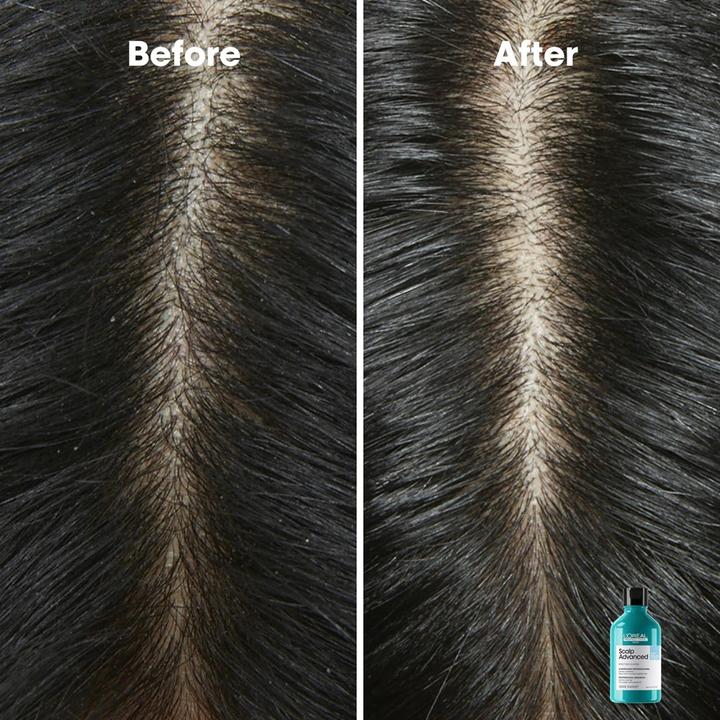 Image du produit L'Oréal Paris L'OrÃ©al Professionnel - (Shampooing Dermo Clarifiant Anti-Dandruff) Scalp Advanced - Volume : 300 (300 ml, Shampoing liquide)