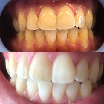 Produktbild SmilePen Power Whitening (1 ml, Bleaching Kit)