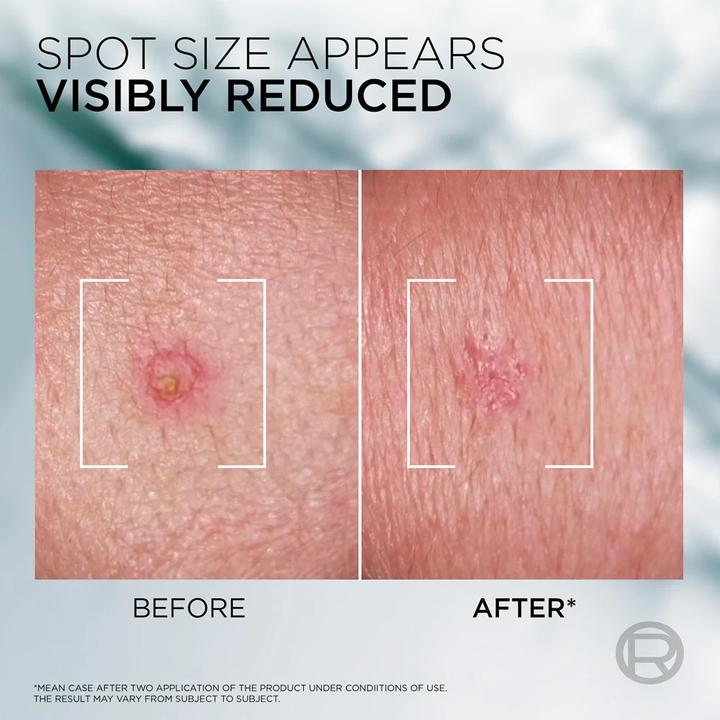 Actual product image L'Oréal Paris Men Expert Derma Control S.O.S Pimple Paste (45 ml)