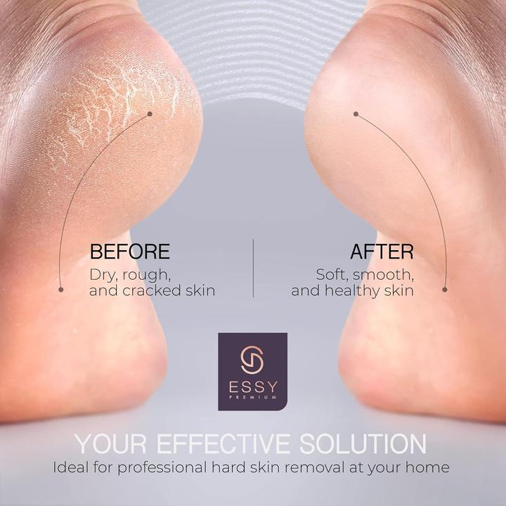 Actual product image Essy Hornhautentferner