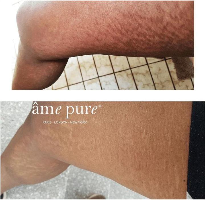 Actual product image Âme pure Basic Stretch Mark Eraser Set