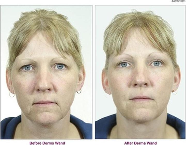 Image du produit DermaWand Dispositif de soins de la peau