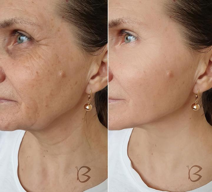 Image du produit Beautifly B Meso