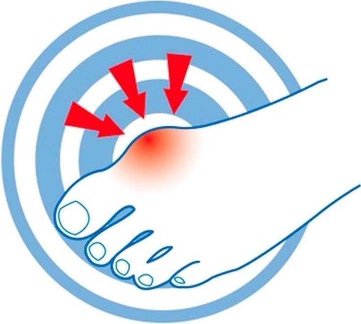 Image du produit Epitact Hallux Valgus Protection Bunion Relief (Déodorants & poudre pour les pieds)