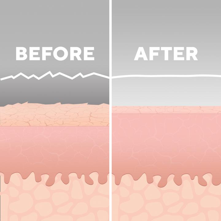 Image du produit Homedics MD-1000 Remove