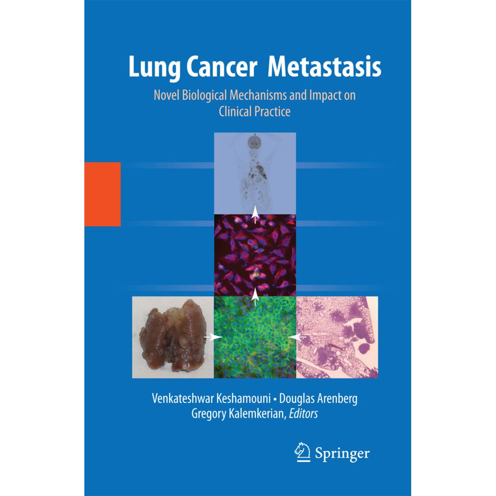 Lung Cancer Metastasis, Fachbücher von Gregory Kalemkerian, Venkateshwar Keshamouni, Douglas Arenberg