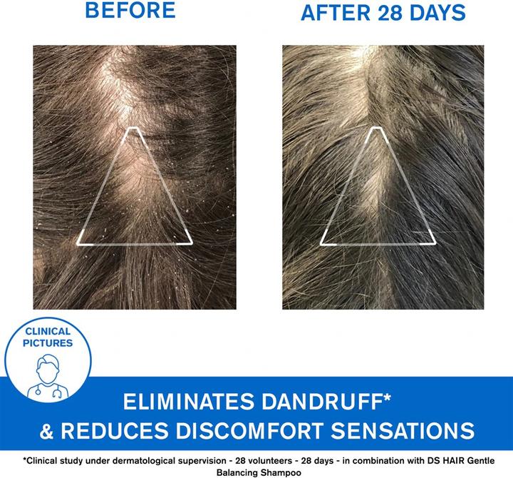 Actual product image Uriage Ds Hair Shampoo Anti-Dandruff Shampoo 200Ml (200 ml, Liquid shampoo)