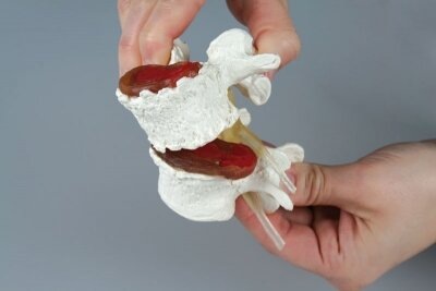 Immagine prodotto Erler Zimmer Modello anatomico Fasi del danno al disco intervertebrale