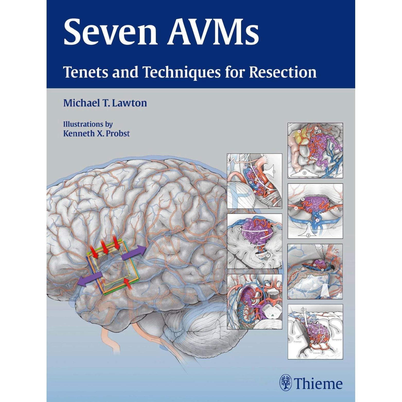 Lawton:Seven AVMs, Fachbücher von Michael T. Lawton