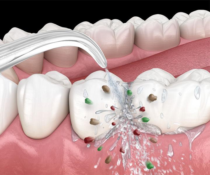 Produktbild Silk'n Munddusche-Set OptiFloss