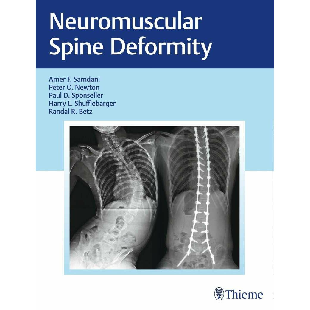 Neuromuscular Spine Deformity, Fachbücher von Harry L. Shufflebarger, Peter O. Newton, Randal R. Betz, Amer F. Samdani, ...
