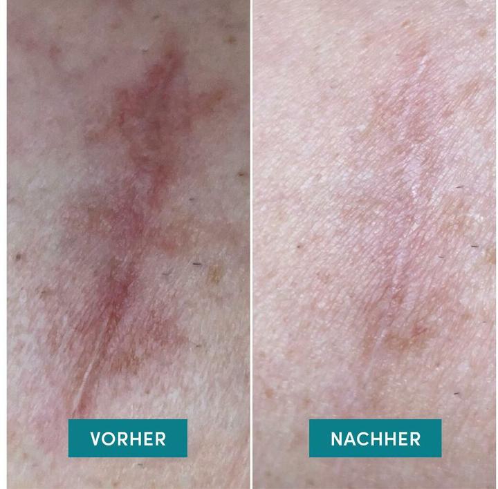 Produktbild Apricot Narbenpads